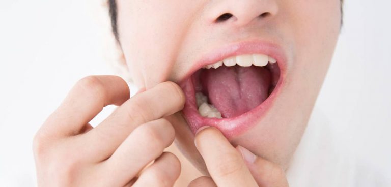 Soigner un aphte : Comment les traiter ?